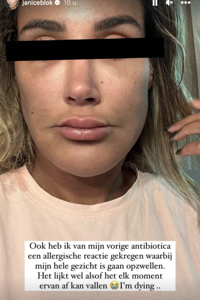 Janice Blok onherkenbaar na heftige allergische reactie 